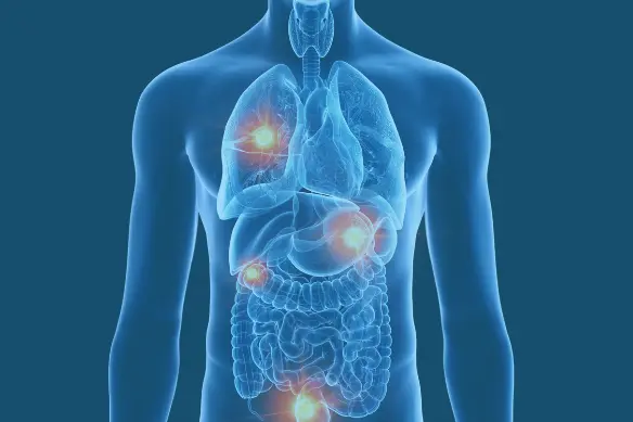 Cancro metastatico, la scienza avanza e iniziano grandi speranze